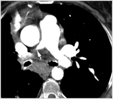 Late-stage TA with right pulmonary artery involvement in a 63-year-old woman.