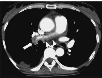 Pulmonary perfusion scan showing perfusion defects through most of the right lung,