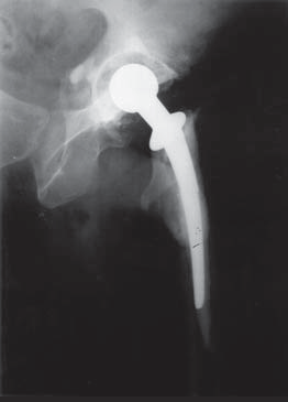 Çimentolu total kaça artroplastisi uygulanmýþ hastada tespit edilen