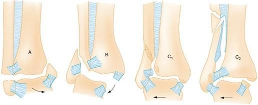 Ayak bileği fraktürlerini, mekanizma, fraktür bölgesi ve ligament yaralanmasına göre derecelendiren farklı