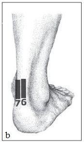 (58) ndan Normal tendonlar, USG görüntüsü olarak ince, düzenli ve düzgün sınırlı hiperekoik bant şeklinde görülür.