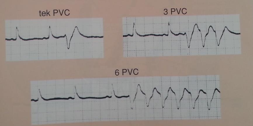 1.4.8 Sürekli olmayan ventriküler taşikardi PVC'Ierin ardı ardına üçten fazla gelmesi sürekli olmayan ventriküler taşikardi olarak adlandırılır.