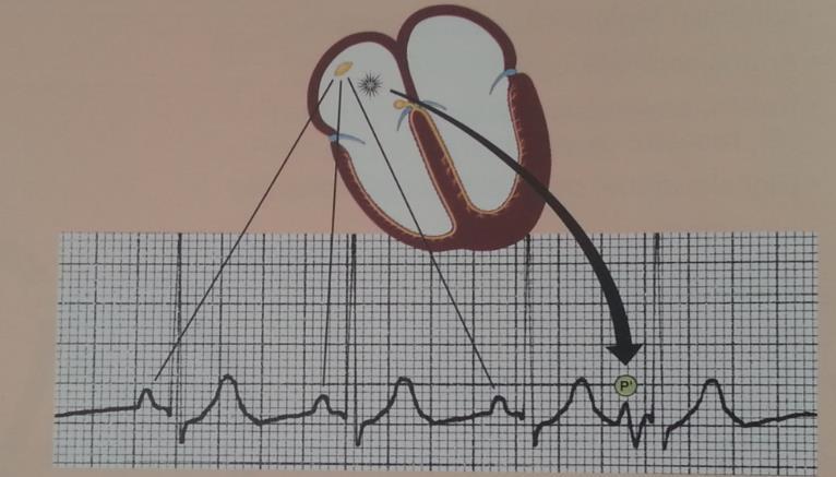 1 ERKEN (PREMATÜRE) VURULAR Kalbin ileti sistemindeki normal uyarı çıkaran bölümler dışındaki hassas (irritabl) bir odağın (ektopik odak) aniden ve beklenenden erken uyarı çıkarmasına erken vuru