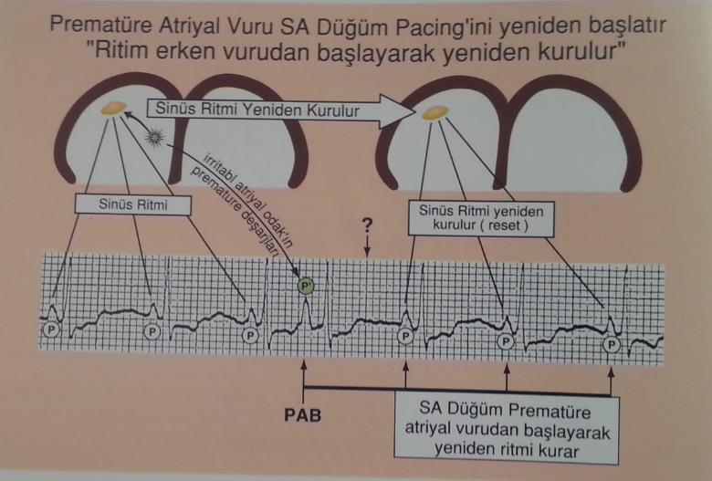 2 WANDERİNG PACEMAKER (GEZİCİ İLETİ MERKEZİ) Uyarı çıkaran baskın pacemaker hücrelerinin SAD ile AVD arasında çeşitli odaklarda değişmesidir.