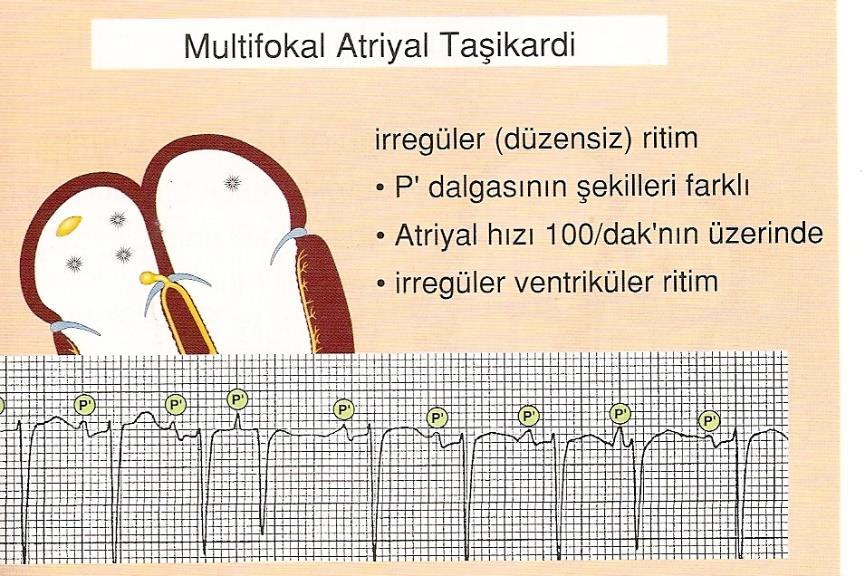 Atriumlarda 3 veya daha fazla odağın bulunduğu dk.da 100 ün üstünde kalp hızı ve farklı biçimli P dalgaları ile karakterizedir. (KOAH hastalarında sık görülür.) Şekil 4.