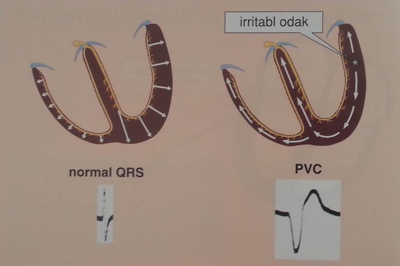 5 Şekil 7. Prematüre Ventriküler Compleks (QRS farkı) Ventriküler ileti normalse sağ ve sol ventriküller simultane olarak (aynı anda) depolarize edilir.