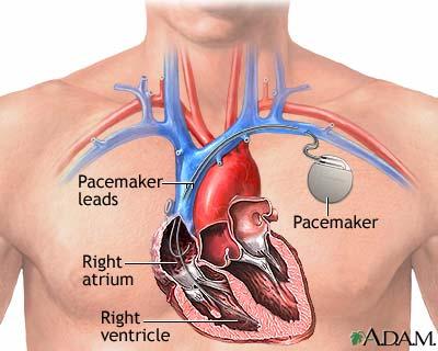 Bradikardiler: 1. MI olmaksızın; a. Semptomatik sinüs nodu disfonksiyonu (sinüs arrest, taşibradi (hasta sinüs) sendromu, sinüs bradikardisi b. 2. ve 3. derece kalp bloğu c.