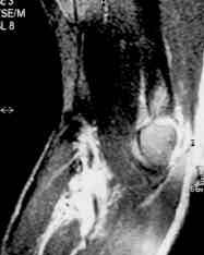 168 Acta Orthop Traumatol Turc nörolojik komplikasyon oran n n azald bildirilmifltir.