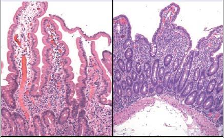 bağlantılar açılmakta, intestinal bariyerden gliadin geçişi gerçekleşmekte ve daha önce de bahsedildiği üzere, gliadinin proinflamatuar mekanizmaları devreye sokması ile ciddi intestinal hasar