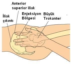 şekilde elini yerleştirir ve orta parmağını işaret parmağından olabildiğince hastanın kalçasına doğru açar. İşaret parmağı, orta parmak ve iliak çıkıntı V biçiminde bir üçgen alan oluşturur.