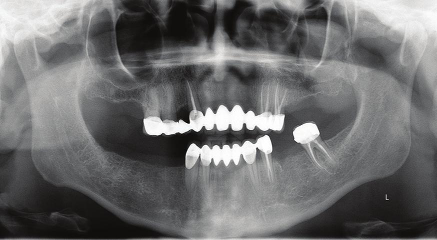üst anterior bölgede bulunan dişlerin morfolojik özellikleri, santral ve lateral dişler olabileceğini düşündürmüştür. Bu nedenle nazal kavitedeki dişin 23 numaralı diş olabileceği kanaatine varıldı.
