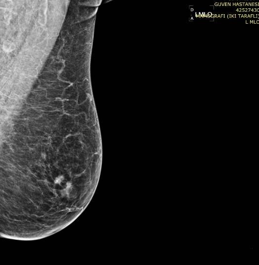yüksek olasılıkla malign kitle (BI-RADS 5) Sol ön