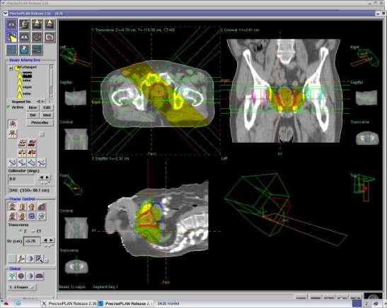 17 Resim 3.2. Precise planlama sisteminden alınan ekran görüntüsü Tomoterapi lineer hızlandırıcı ve planlama sistemi Tomoterapi sözcüğü kesit tedavisi anlamına gelmektedir.