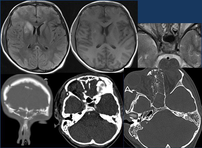 thalamus ve beyin sapı hiperdens) White cerebellum-serebellum iskemik serebruma göre daha hiperdens görünmesi) Parankimal kontüzyon Atrofi Ensefelomalazi Görüntüleme bulguları AHT Ayırıcı Tanı