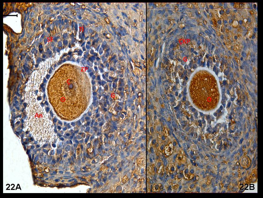 Resim 22A,B: Hormon uygulaması yapılan gruba ait ovaryum dokusunda c-fos immünreaktvitesinin daha büyük büyültmelerde çekirdek ile sitoplazma düzeyinde yaygın olduğu ayırt ediliyor.