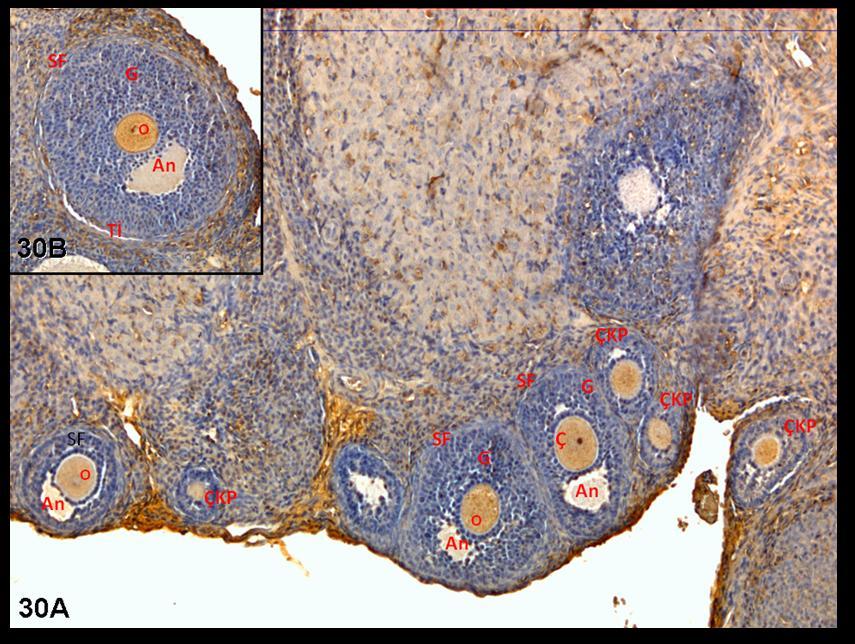 Resim 30A,B: Klomifen sitrat uygulaması yapılan gruba ait ovaryum dokusunda c-fos immünreaktivitesinin doku genelinde stromada daha belirgin olduğu görülüyor.