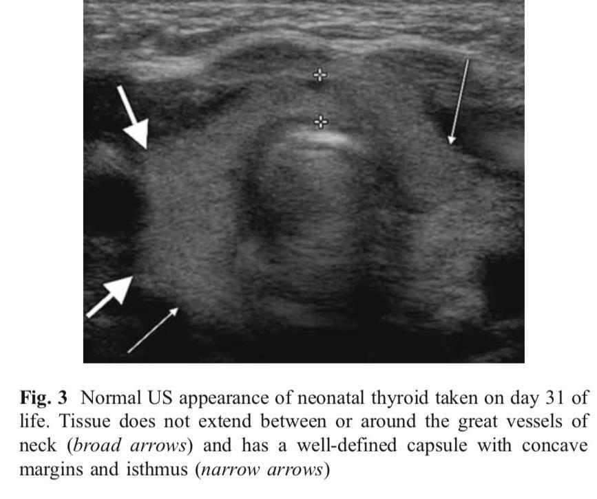 Heterogeneous tissue in the thyroid fossa on ultrasound