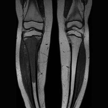 () ve () SE T1 ağırlıklı koronal görüntülerde, sağ tibya metafizo-diyafizer yerleşim gösteren, proksimalde büyüme hattına dayanan, medullada hipointens lezyon, distal uçta diyafizde normal yağlı