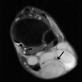 MRG de T1- görüntülerde multilobule, hipointens kitle lezyonu olup içinde hiperintens yağ septaları ve fokal yağ adacıkları mevcuttur.