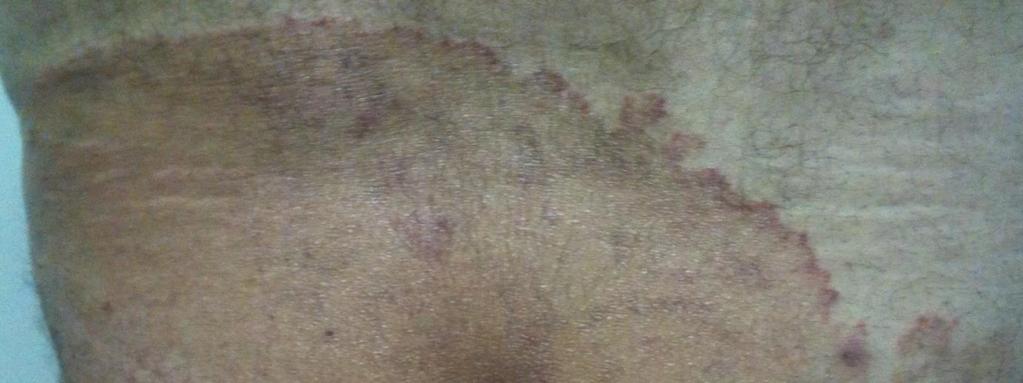 Neglected Tinea Inguinalis SIROM 2014; 2(1): 27-31 yazdırmış, ancak muayene olmamış. Çekindiği için de aile hekimine durumunu anlatamamış.