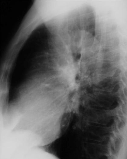 Sol pulmoner arter Sağ üst lob bronşu