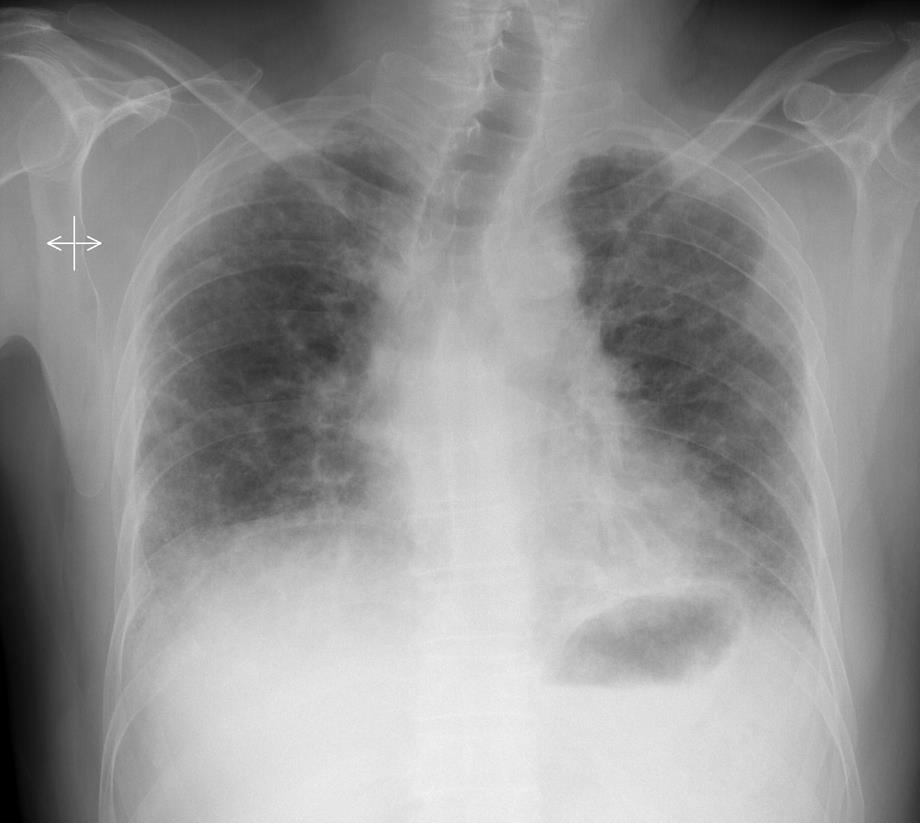 4 İdyopatik pulmoner fibrozis: Her iki akciğer