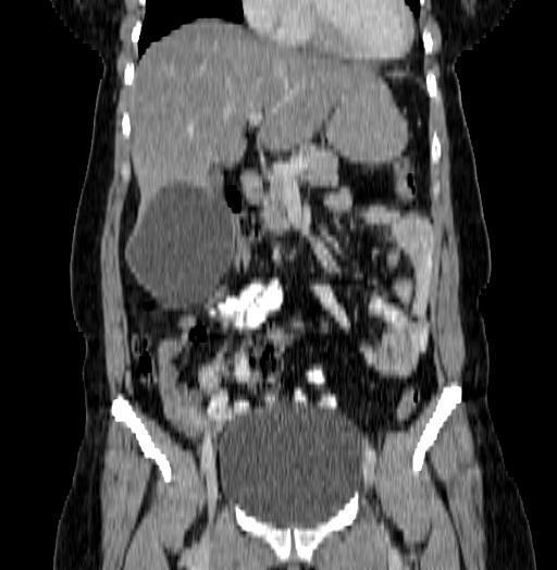 7 karaciğer Aynı hastanın abdomen BT tetkikinden oluşturulan koronal