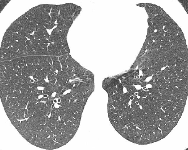 hipersensitivite