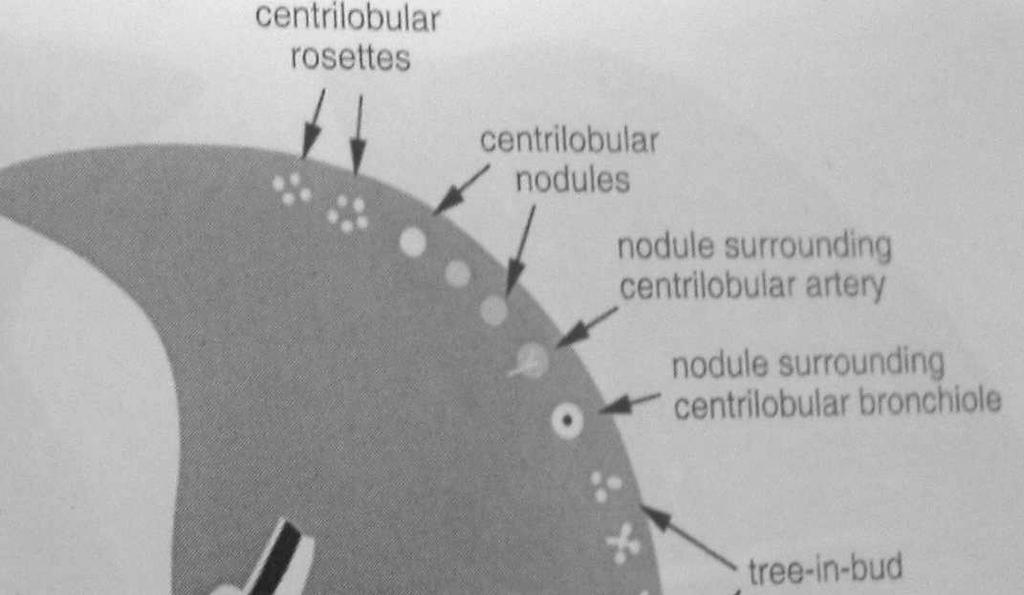 Sentrlobüler nodül Sentrlobüler