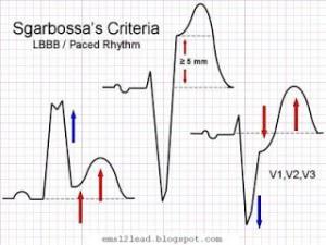 LBBB ve ST Elevasyonu Sgarbossa Kriteri Pozitif QRS kompleksi olan derivasyonlarda > 1 mm konkordan (aynı yönlü) ST