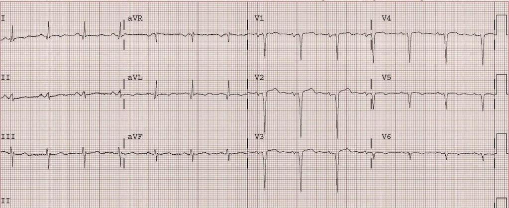 V1-V4 de T/QRS 0.36< ise MI < 0.