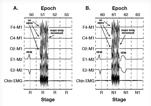 a. EEG, K kompleksleri veya uyku iğcikleri olmadan LAMF EEG aktivitesi gösterir b. Epoğun büyük kısmında çene EMG tonüsü düşüktür (evre R seviyesinde) c. Araya giren bir arousal yoktur 6.