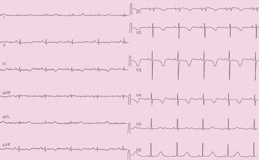 EKG Genelde Ca <6.