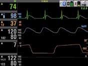 Ana Ekran Alarm limitleri Kalp sembolü Zaman Bluetooth göstergesi Pil göstergesi Alarm Göstergesi Kalp Atım Hızı HR 150 50 J Seçilen enerji EKG Derivasyonu/Boyut SpO 2 /SpCO/ SpMet SPO2 % CO2 mmhg