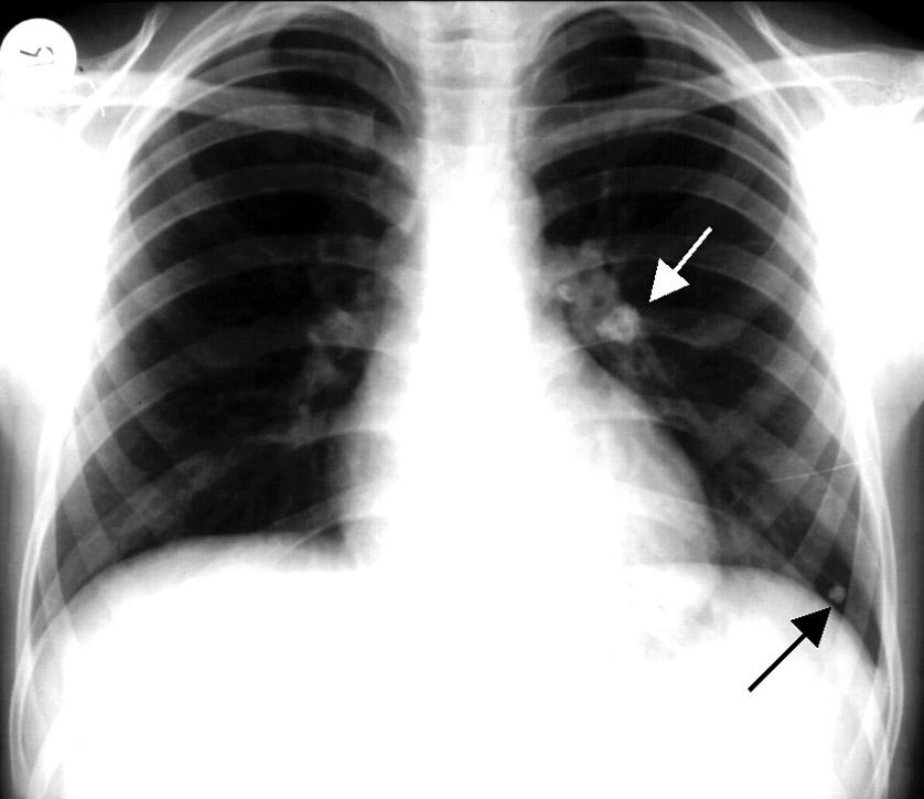 Ar yürek, Gülsün: Akci er tüberkülozunun radyolojik bulgular 41 sonra ba fl kl n azald durumlarda bu basiller reaktive olarak postprimer tüberküloza sebep olabilirler (3).