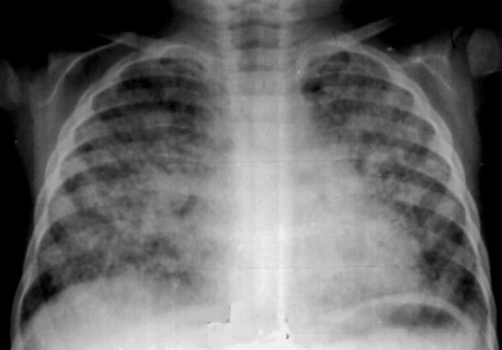 Ar yürek, Gülsün: Akci er tüberkülozunun radyolojik bulgular 43 Plevral efüzyon: Tüberküloz plörit, primer enfeksiyonun geç bulgular ndand r ve 3-7 ay sonra ortaya ç kar (7).