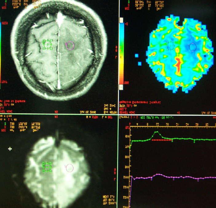 4.3 Olgu Örnekleri A D B C Şekil 4.1; Evre II oligodendrogliyoma (ODG) olgusu, 37 yaşında erkek hasta. A. Aksiyel EPI-GRE görüntüsünde solda verteks düzeyinde frontoparietalde daha çok kortikal yerleşimli, hiperintensiye neden olan lezyon izlenmektedir.