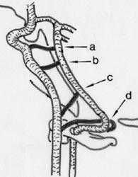 Çizim. Persistan fetal karotid vertebrobaziler anastomozlar. Karotis ve baziler arterler aras nda normal geliflimde yaln zca posterior komünikan arter bulunur.