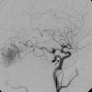 MR anjiyografik kaynak görüntüde yap n n vasküler nitelikte sol karotisten baziler artere uzad izleniyor. C.