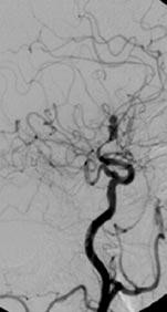 Selektif sol vertebral artere yönelik anjiyogramda (C) vertebral arterin postero-inferior serebellar arterin