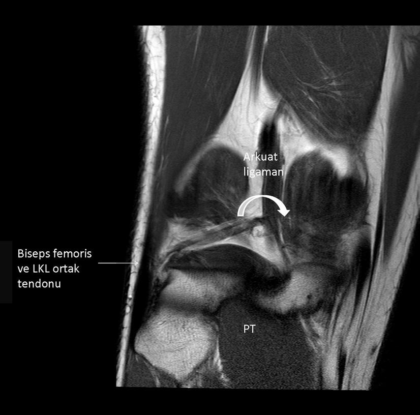 tendonu lateral kollateral ligaman altında lateral femoral sulkustaki yerine ulaşır.