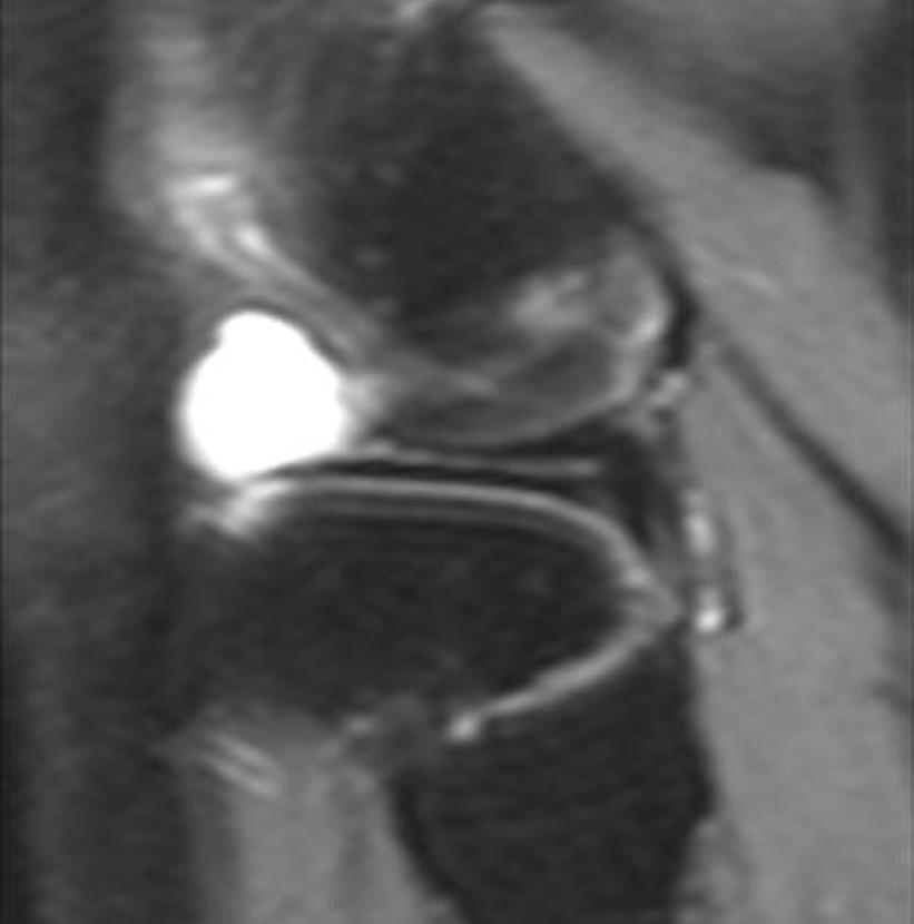 444 Sanal T. H. Resim 7. Diz eklemi lateralinde kitle şikayeti ile gelen olguda sagital YB T2-a görüntüde lateral menisküsteki horizontal yırtığa eşlik eden parameniskal kist görülmektedir.