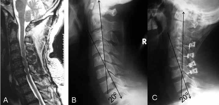 Ameliyat sonrası (AS) yan servikal x- ray grafisi. Servikal lordoz açıları resmin üzerinde ölçülerek gösterilmiştir. I.