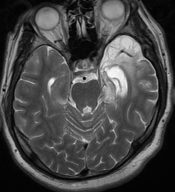 Bir başka hastada kronik dönemde mevcut olan sol temporal lobda atrofi, ensefalomalazik değişiklikler ve ventrikülde genişleme 1. Baringer JR. Herpes simplex infections of the nervous system.