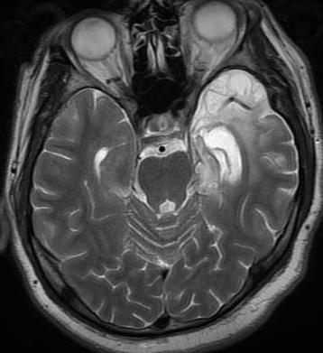 Neuroimaging of herpesvirus infections in children. Pediatr Radiol 2007;37:949-63. 4. Parmar H, Ibrahim M. Pediatric intracranial infections. Neuroimaging Clin N Am 2012;22:707-25. 5. Whitley RJ.