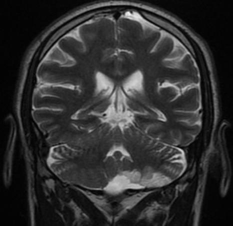 Serebellar hamartom, ganglionörom, purkinjom, serebellar korteksin diffüz hiperplazisi olarak da bilinir (3).