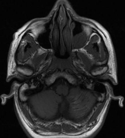 a b Resim 3. T1 ağırlıklı aksiyel MR görüntüsünde sol serebellar hemisfer inferior kesimini tutan serebellar folyalarda kalınlaşmaya neden olan çevresi hipointens lezyon görülmektedir (a).