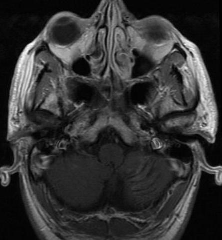 Tartışma Lhermitte-Duclos hastalığı diğer bir tanımlama ile serebellar korteksin displastik gangliositomu, ender görülen bir patolojidir.