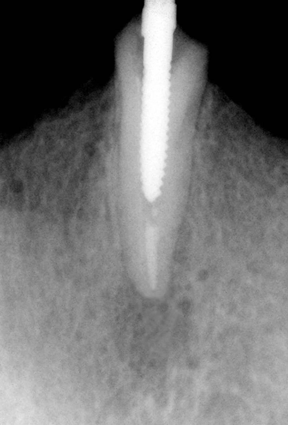 Kırılmış bir anterior dişin prefabrik post desteği ve kendi kırık parçası ile restore edilmesi Resim 4. Kor parçanın düzenlenmesi.