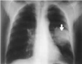 Şekil.4:Akciğer üzerindeki kanser oluşmuş hali [5] Akciğer bronş mukozasında oluşan kanser hücreleri bronş boşluğu olan lümeni tıkayabilir.